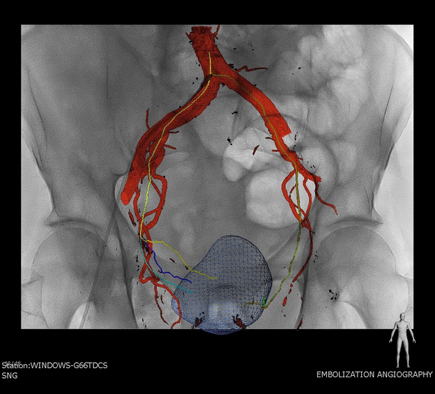 Embolization Angiography