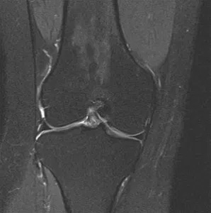 MRI Arthrography