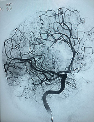 Digital subtraction angiogram of the <br>internal carotid and cerebral arteries