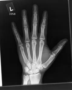 X-Ray