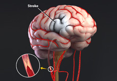 Stroke Intervention