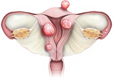 Uterine fibroids